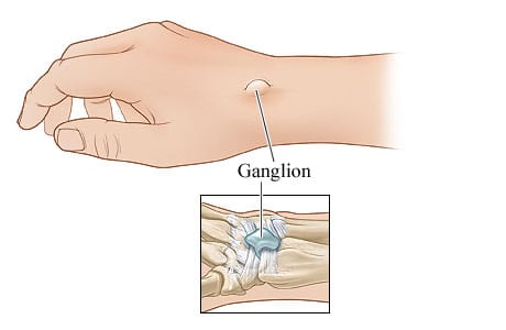 Ganglion on wrist, with detail of internal view.