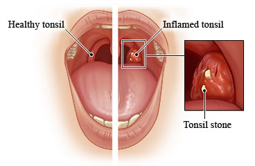 Healthy tonsil versus inflamed tonsil, with detail of tonsil stone on inflamed tonsil.