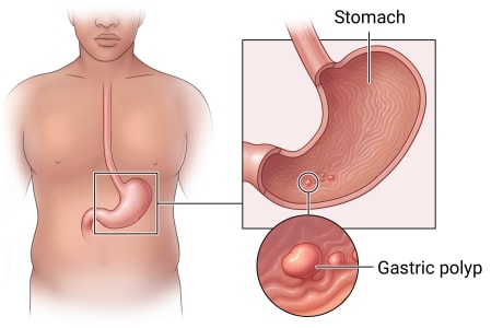Location of stomach in upper belly, with detail of stomach lining with polyps and close-up of a gastric polyp.