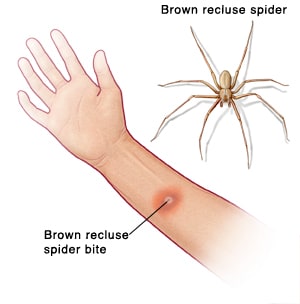 Palm view of hand and forearm showing brown recluse spider bite on arm. Picture of brown recluse spider.