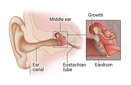 Anatomy of child's ear, showing ear canal, middle ear, and eustachian tube, with detail of growth behind eardrum in middle ear.