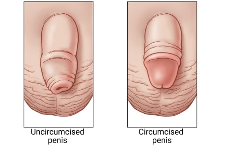 Uncircumcised penis with foreskin still in place, and circumcised penis with foreskin removed.
