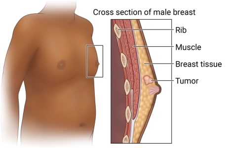 Cross section of male breast, showing layers of ribs, muscles, and breast tissue, with tumor in breast tissue.