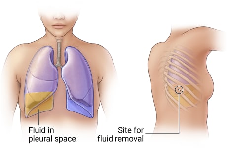 Lungs in chest showing fluid in right pleural space, and view of person's back showing site between two ribs for fluid removal.