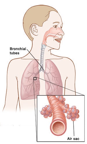 Illustration showing the position of the lungs and bronchial tubes, with a close-up view of an air sac.