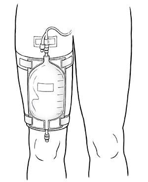 Front view of leg showing urinary catheter bag strapped to thigh and connected to indwelling catheter.