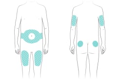 Locations on body for giving insulin shots, including on belly around navel, thighs, back of upper arms, and upper buttocks.