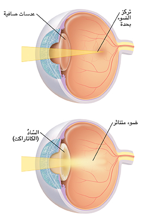 صورة ثلاثية الأرباع للعين تُظهر العدسات تركز بشدة على الضوء. صورة ثلاثية الأرباع للعين تُظهر إعتام عدسة العين المشتتة للضوء.