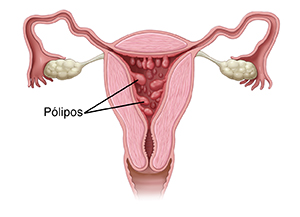 Corte transversal do aparelho reprodutor feminino em vista frontal mostrando pólipos no útero.