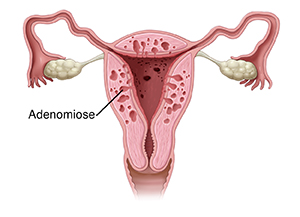 Corte transversal do útero em vista frontal mostrando adenomiose.
