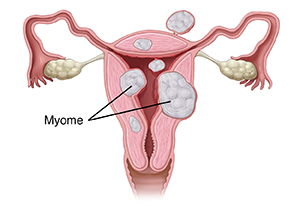 Vorderansicht eines Querschnitts einer Gebärmutter mit drei Arten von Myomen.