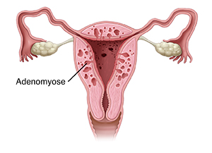 Vorderansicht eines Querschnitts einer Gebärmutter mit Adenomyose.