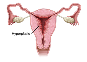 Vorderansicht eines Querschnitts eines weiblichen Fortpflanzungstrakts mit Endometriumhyperplasie.