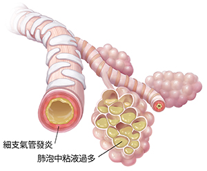 肺炎使得細支氣管和肺泡囊黏液堆積並引發炎症。