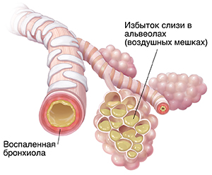 Из-за пневмонии в бронхиолах и альвеолярных мешочках скапливается слизь.
