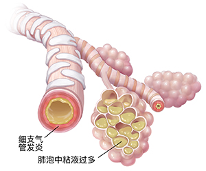 因肺炎链球菌而产生积液和炎症的细支气管和肺泡小囊。