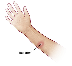 Palm view of hand and forearm showing tick bite on arm.