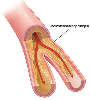 Querschnitt einer Arterie mit Plaqueablagerungen und eingeschränktem Blutfluss.