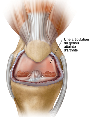 Vue de face de l'articulation du genou montrant de l'inflammation et de l'arthrite.