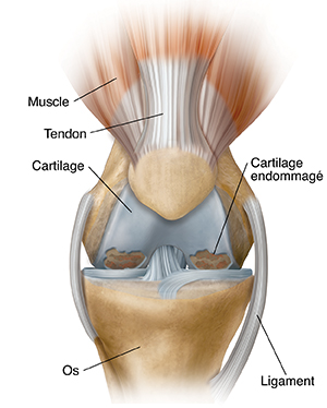 Vue antérieure d'un genou souffrant d'arthrose.