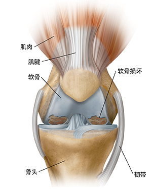 显示骨关节炎的膝盖前视图。
