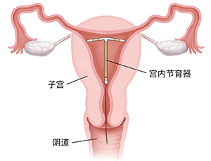 子宫和阴道横截面，显示宫内节育器在子宫内的位置。