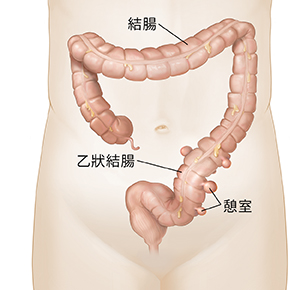 下部有囊袋狀憩室的結腸的前視圖。