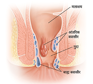 बवासीर को दर्शाता हुआ मलाशय और गुदा का क्रॉस सेक्शन।