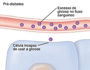 Corte transversal de um vaso sanguíneo e células, mostrando um nível de glicose excessivo devido ao pré-diabetes.