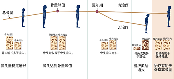 显示女生一生中骨头生长和流失的图形，包含和不含骨质疏松症的治疗。