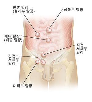일종의 탈장이 있는 남성 복부의 전면 모습.