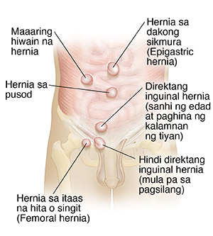 Harapang kuha ng tiyan ng lalaki na ipinakikita ang mga uri ng mga hernia.