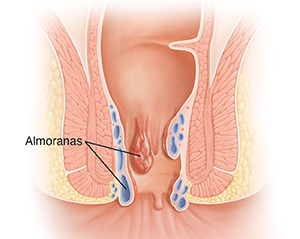 Cross section ng tumbong na puwit na ipinakikita ang almoranas.