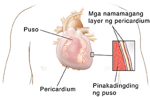 Balangkas ng dibdib ng tao na nagpapakita ng puso at pericardium. Malapitang kuha ng hinating bahagi na nagpapakita ng dalawang salansan ng namamagang pericardium na may likido sa pagitan nito sa pinakataas na dingding ng puso.