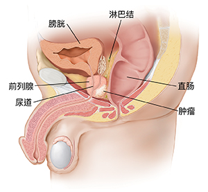 显示前列腺肿瘤的男性盆腔器官侧视图。