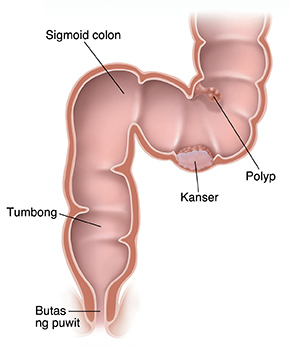 Cross section ng sigmoid colon, tumbong, at puwit na ipinakikita ang kanser at polyp.