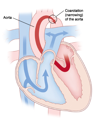 Cross section of heart showing coarctation (narrowing) of the aorta. 