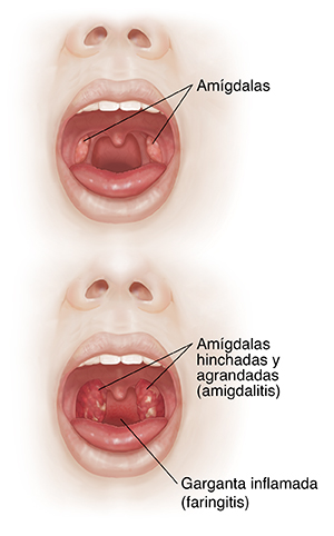 Front view of face with open mouth comparing tonsils with inflamed throat and swollen tonsils.