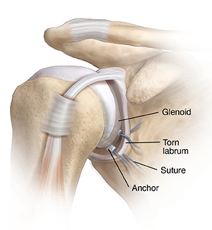 Front view of shoulder joint showing tears at top and bottom of labrum. Anchors are placed to repair tears.