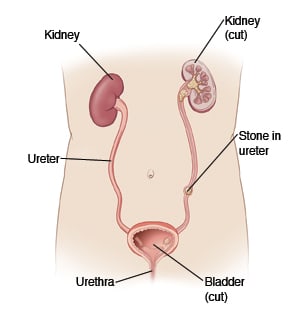Kidney and bladder location, with kidneys, ureters, bladder, urethra, and stone in ureter.