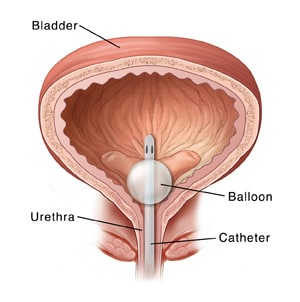 Front-view cross-section of bladder and urethra, showing catheter inserted through urethra into bladder with balloon on end of catheter holding catheter in place. 