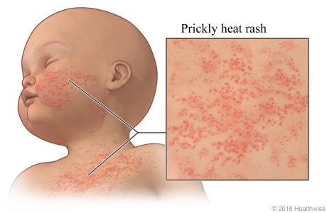 Heat rash on a baby's chest and cheek, with close-up of the rash.