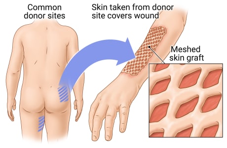 Location of some common sites on the body for donor skin, with detail of meshed skin graft covering wound.