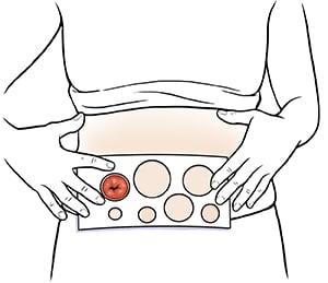 Closeup of abdomen showing hands holding measuring guide to stoma.