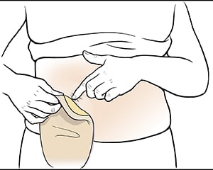 Closeup of abdomen showing hands removing pouch.
