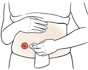 Closeup of abdomen showing hands cleaning around stoma.