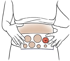 Closeup of abdomen showing hands holding measuring guide to stoma.