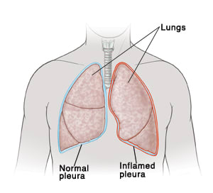 Front view of man's neck and chest showing right lung covered by normal pleura. Left lung is covered by inflamed pleura.