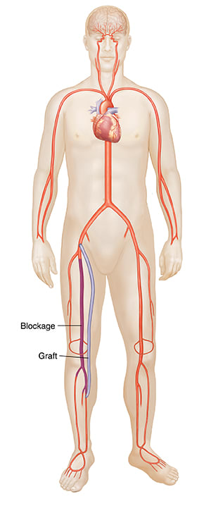 Front view of male figure showing distal bypass graft.
