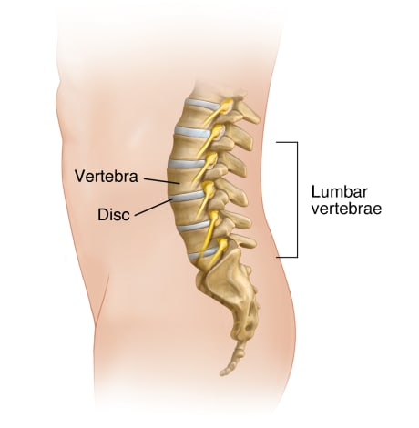 Side view of person, showing lumbar spine anatomy, including vertebrae and discs.